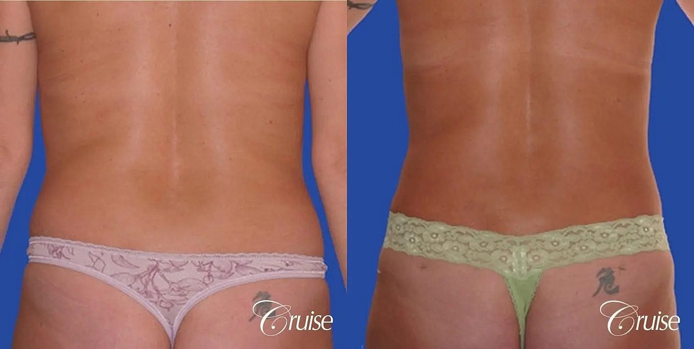 Tummy Tuck Before & After
