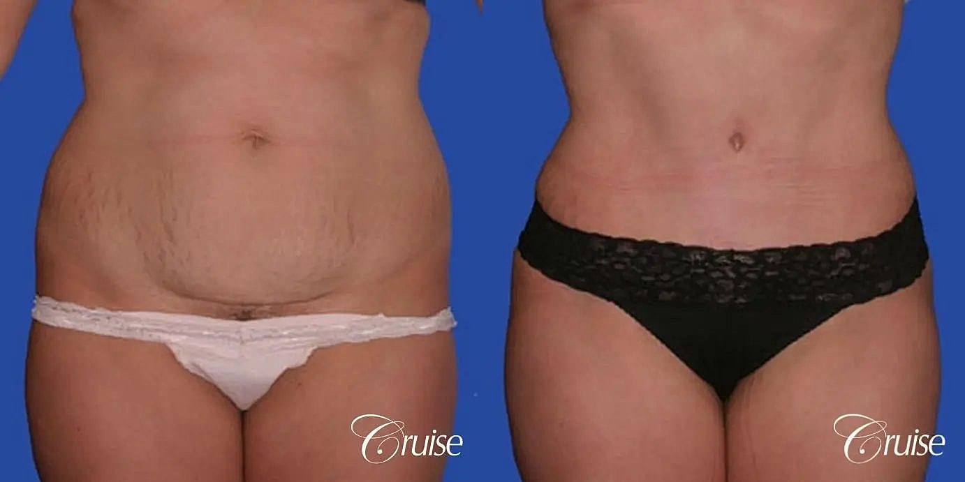 Tummy Tuck Before & After