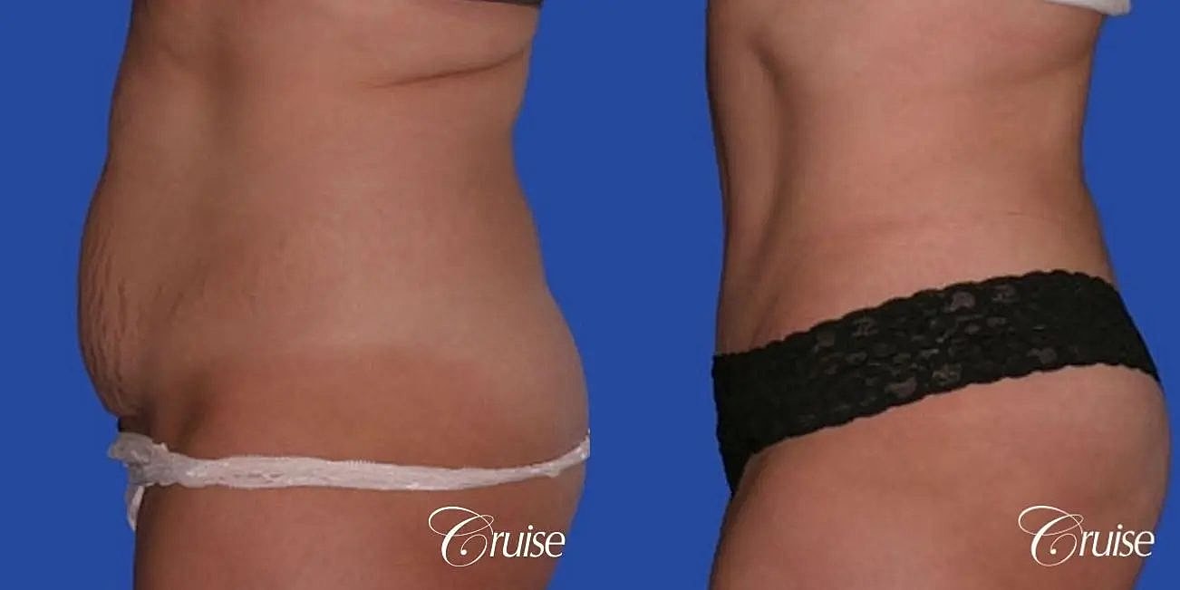Tummy Tuck Before & After