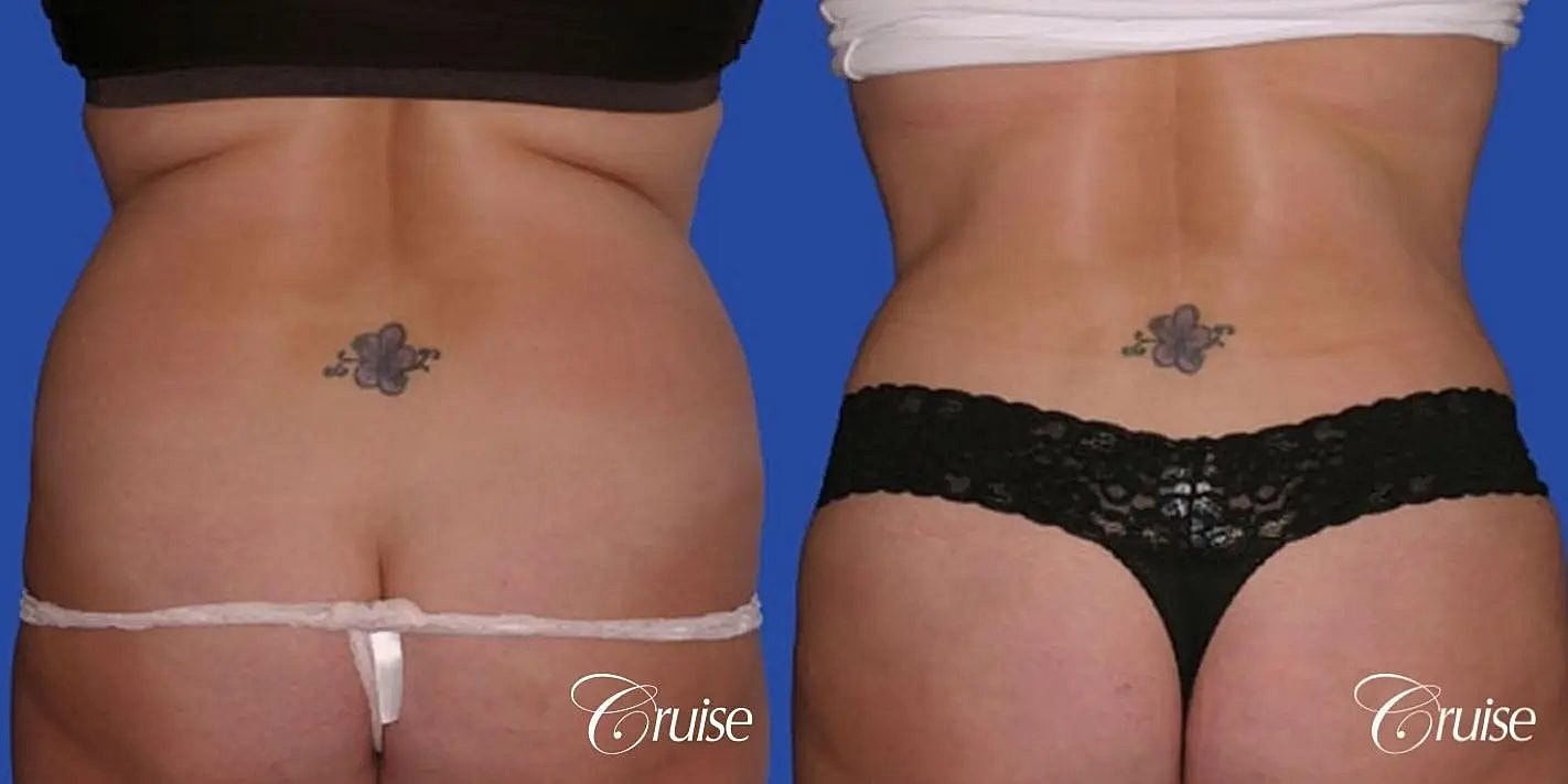 Tummy Tuck Before & After