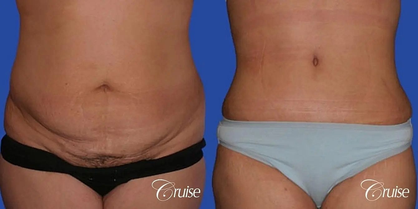 Tummy Tuck Before & After