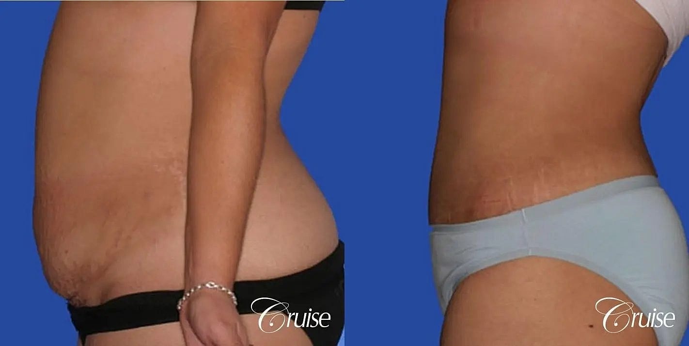 Tummy Tuck Before & After
