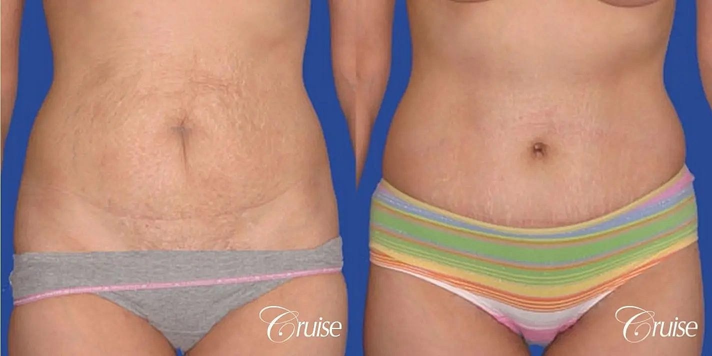 Tummy Tuck Before & After