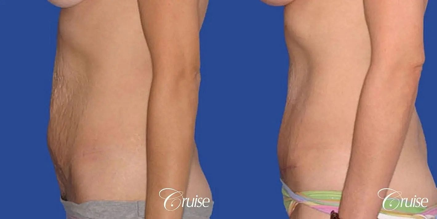 Tummy Tuck Before & After