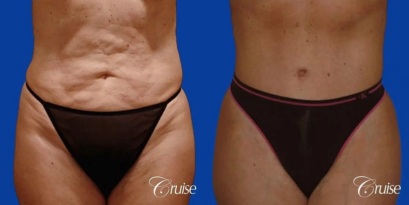 Tummy Tuck Before & After
