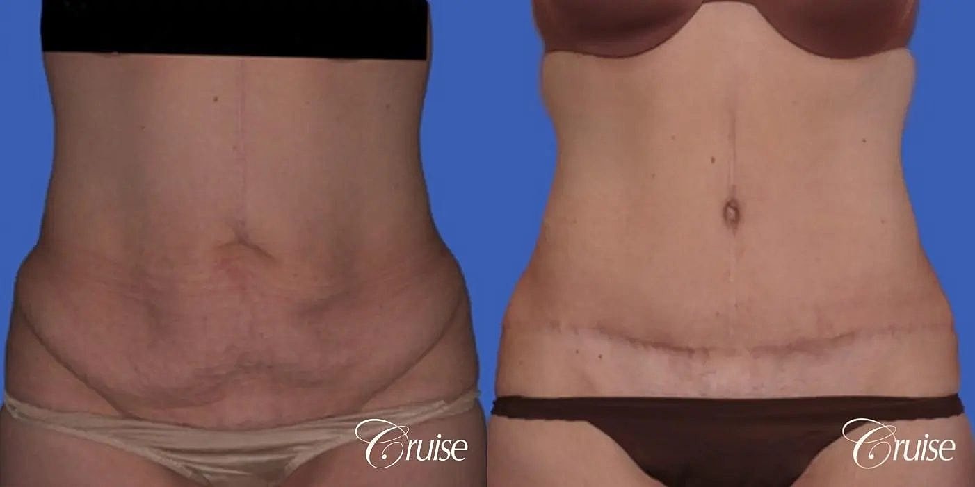Tummy Tuck Before & After