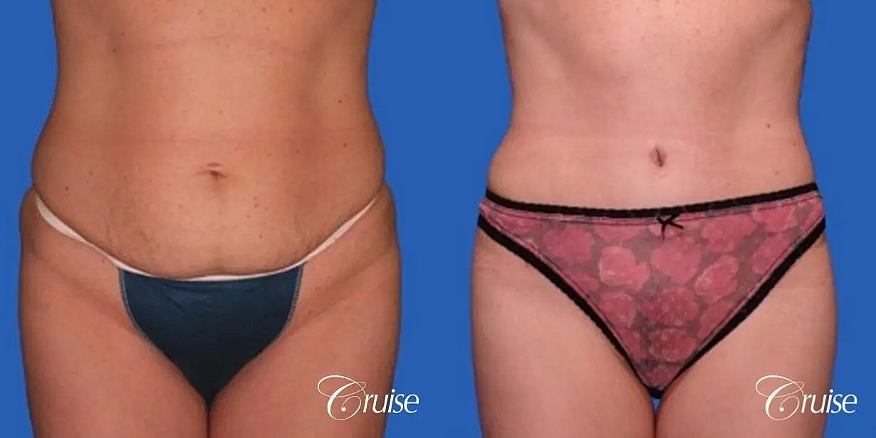Tummy Tuck Before & After
