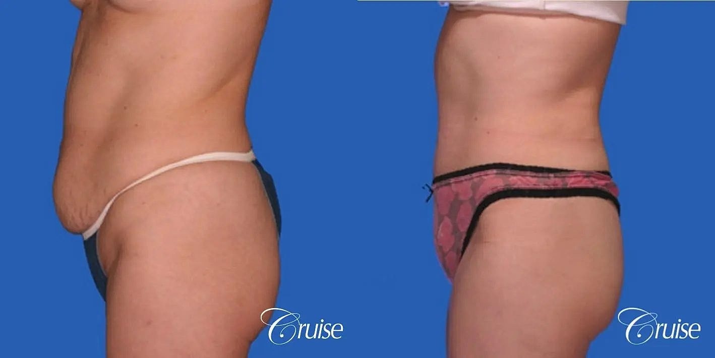Tummy Tuck Before & After