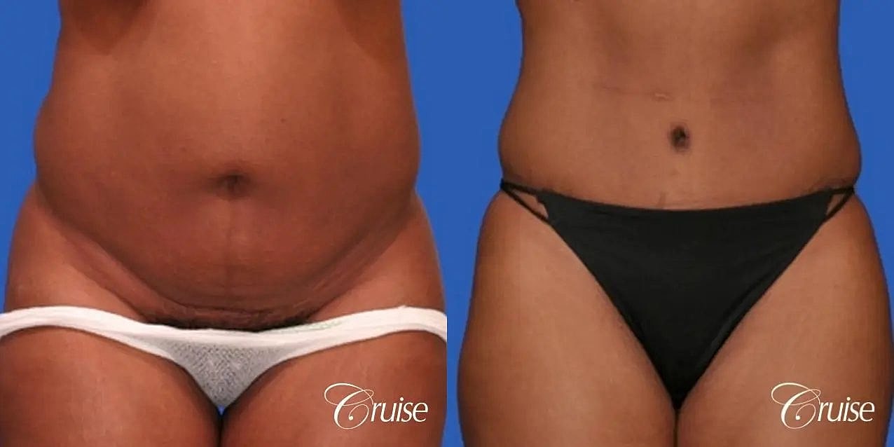 Tummy Tuck Before & After