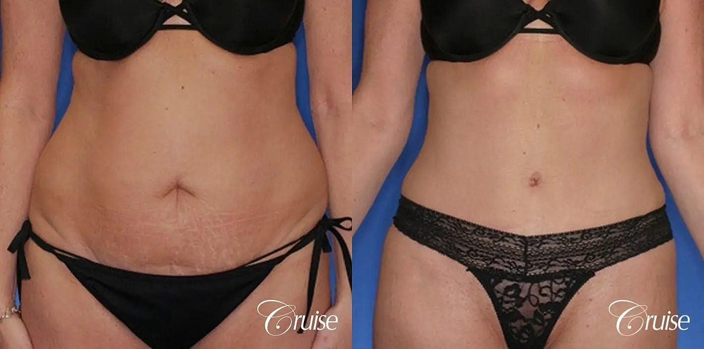Tummy Tuck Before & After