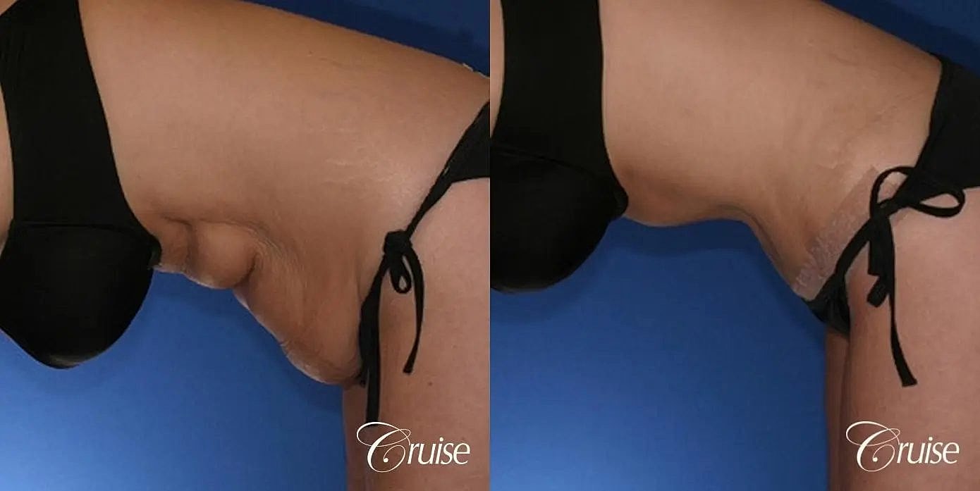 Tummy Tuck Before & After