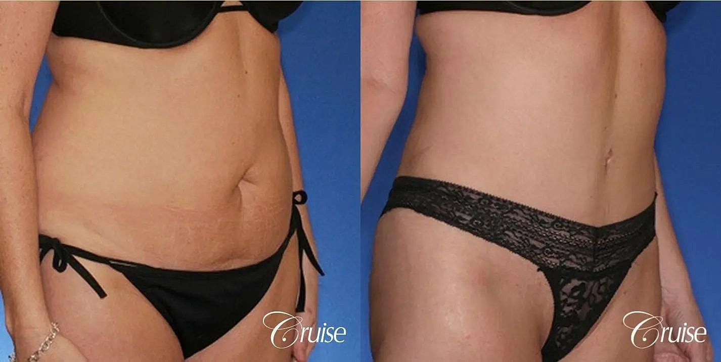 Tummy Tuck Before & After