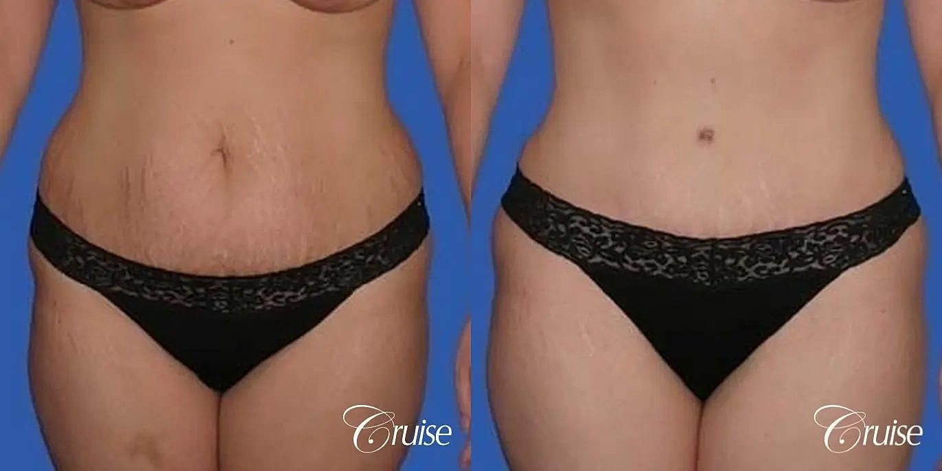 Tummy Tuck Before & After