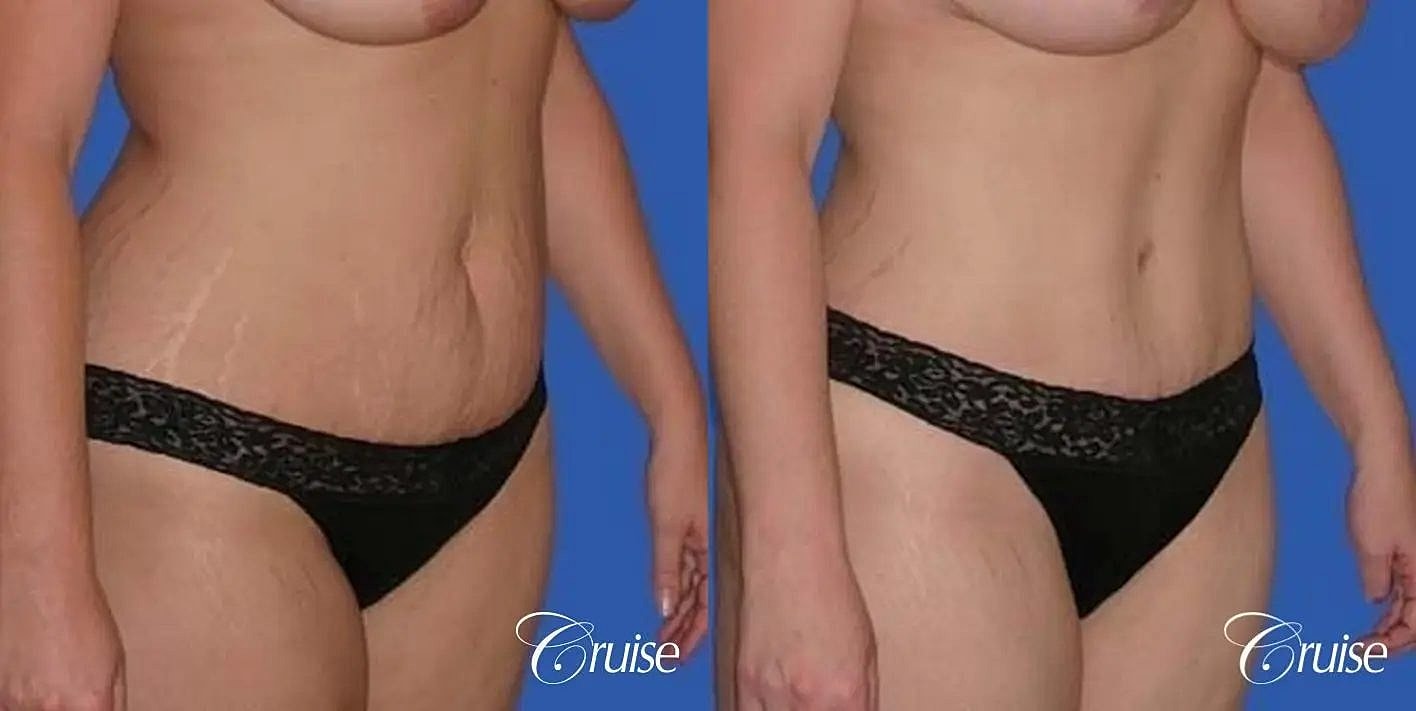 Tummy Tuck Before & After