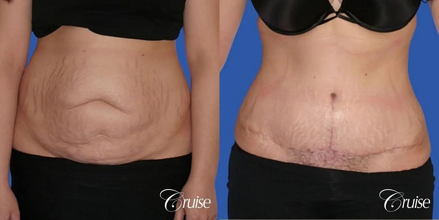 Tummy Tuck Before & After