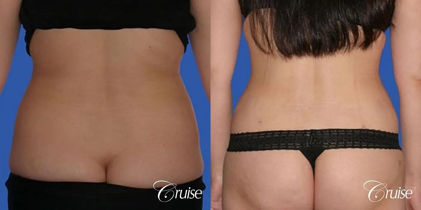 Tummy Tuck Before & After