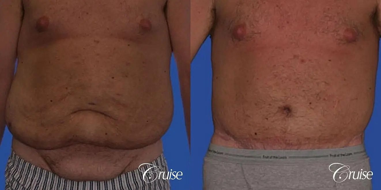 Tummy Tuck Before & After