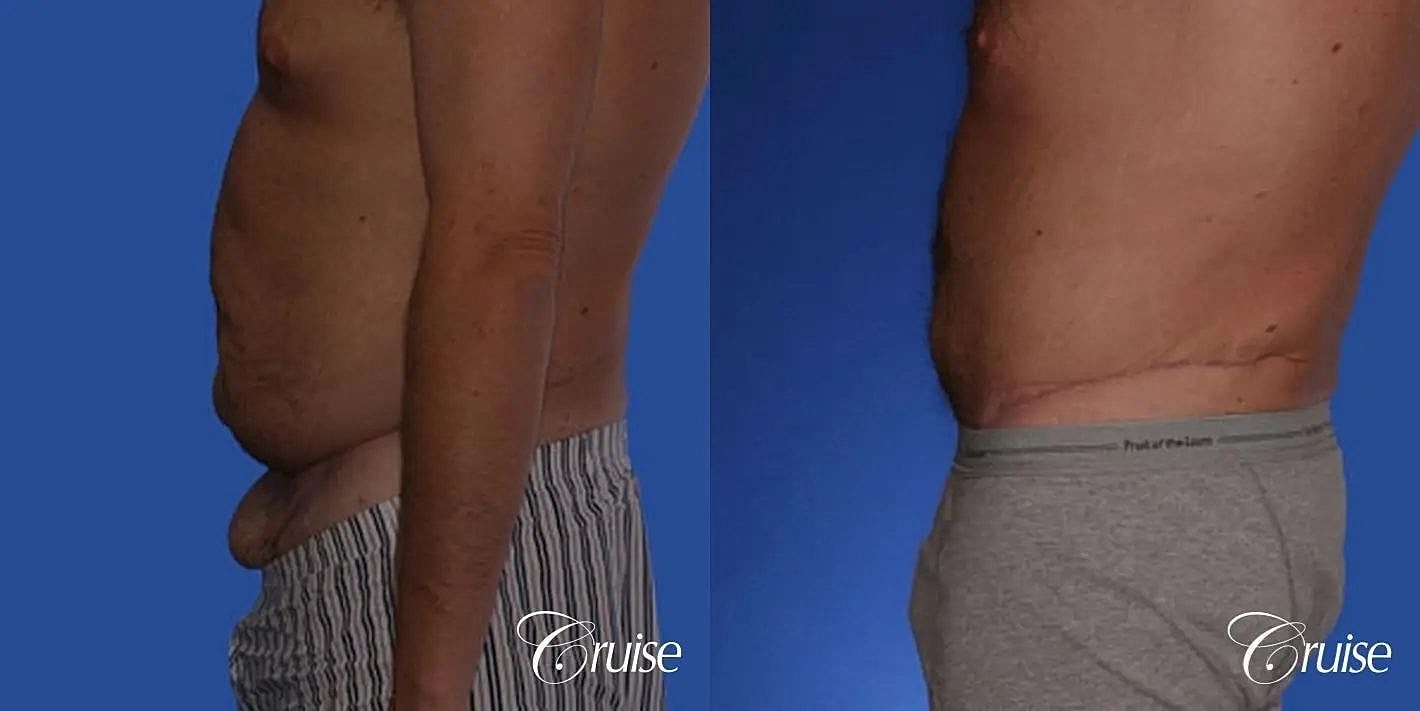 Tummy Tuck Before & After