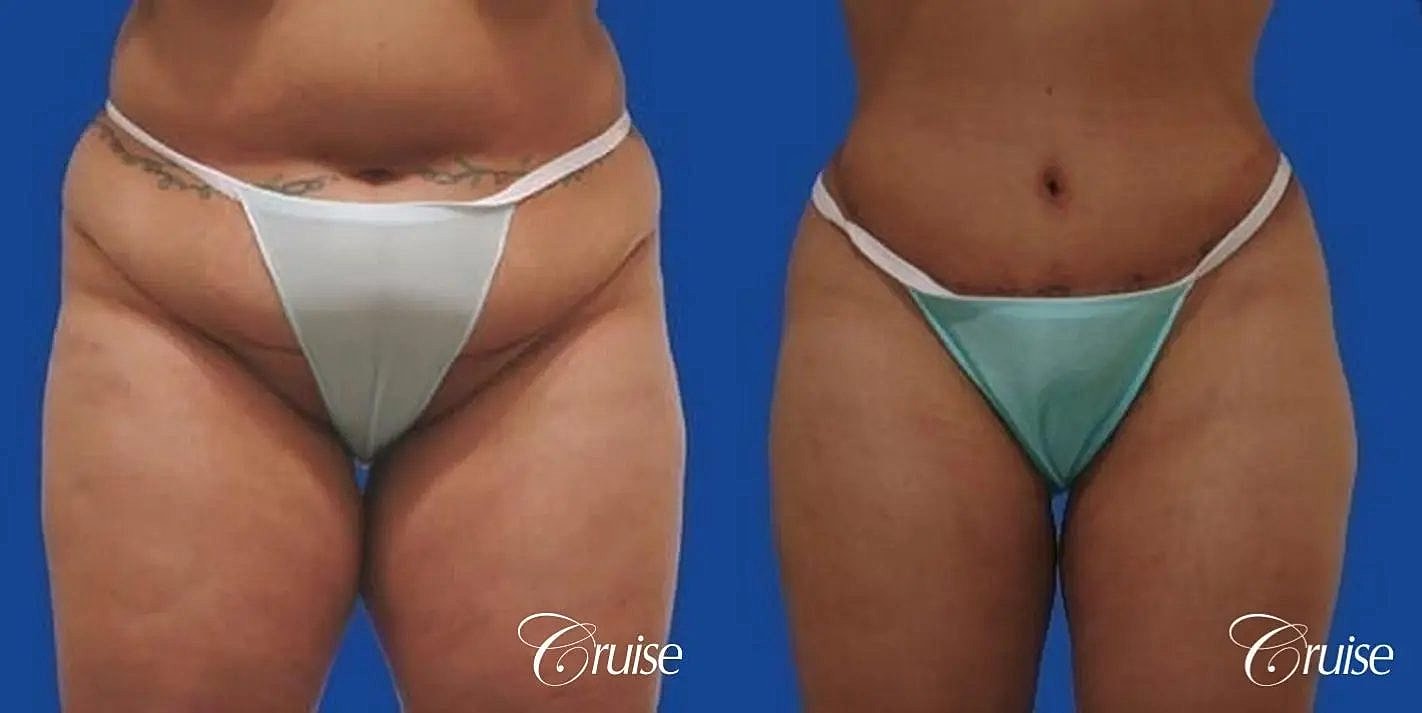 Tummy Tuck Before & After