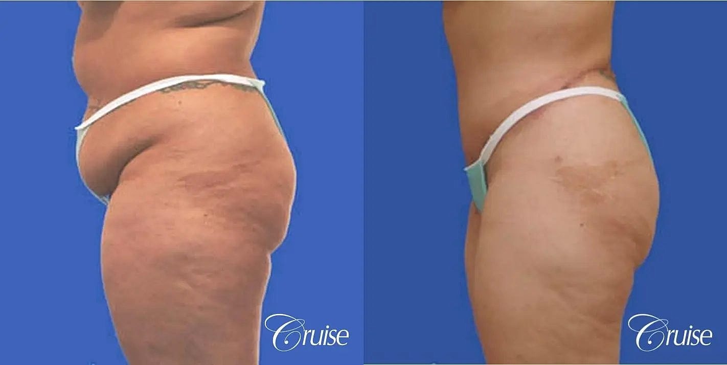 Tummy Tuck Before & After