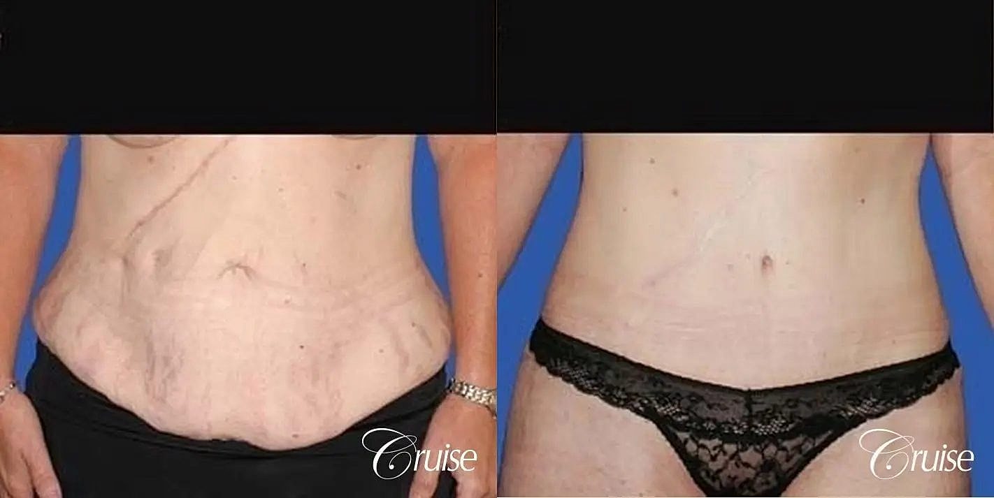 Tummy Tuck Before & After