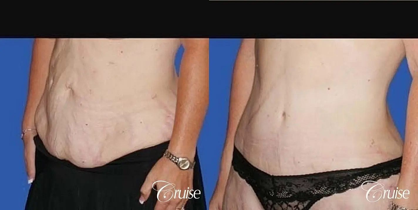 Tummy Tuck Before & After