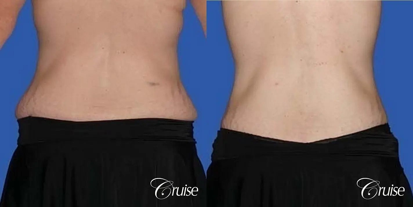 Tummy Tuck Before & After