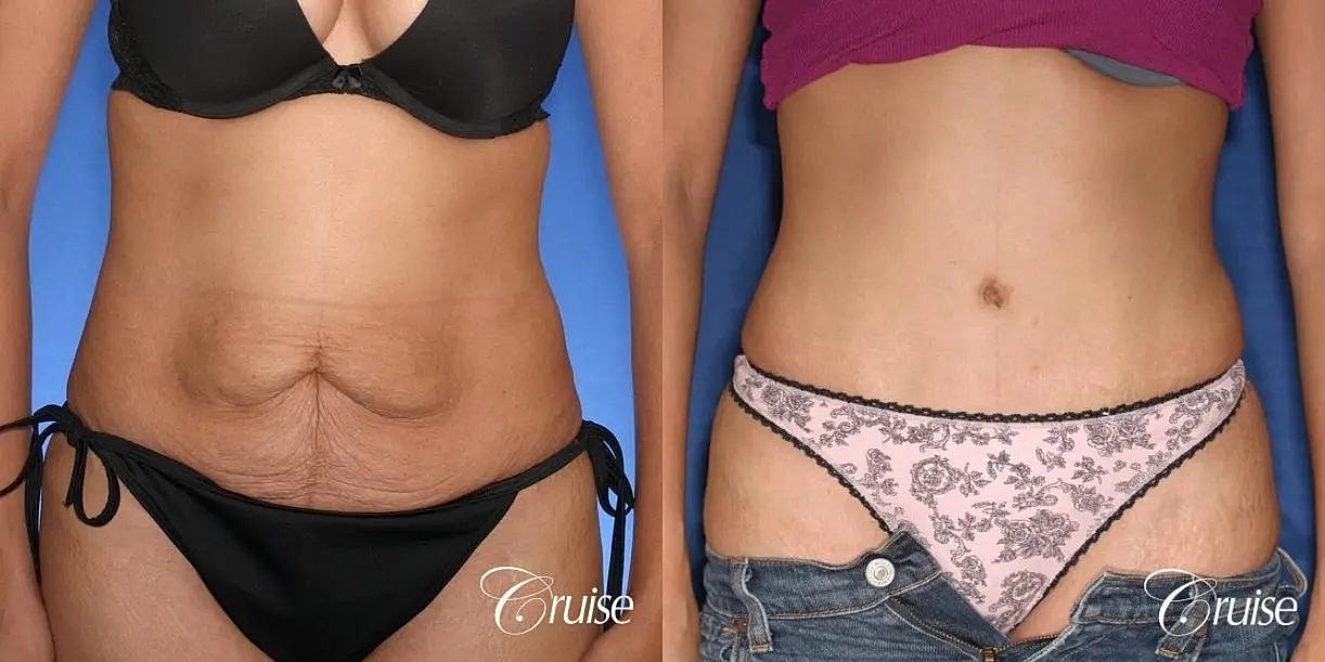 Tummy Tuck Before & After