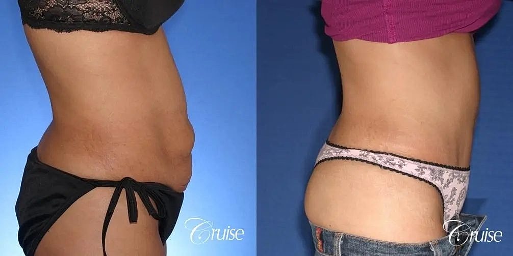 Tummy Tuck Before & After