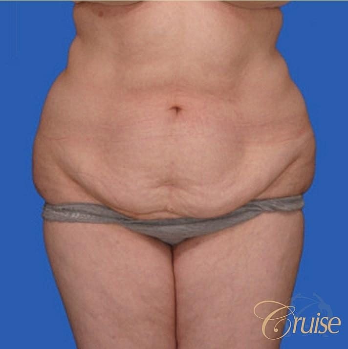 Tummy Tuck Before & After