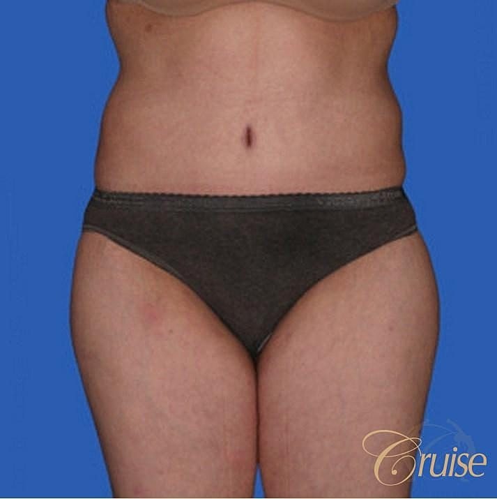 Tummy Tuck Before & After