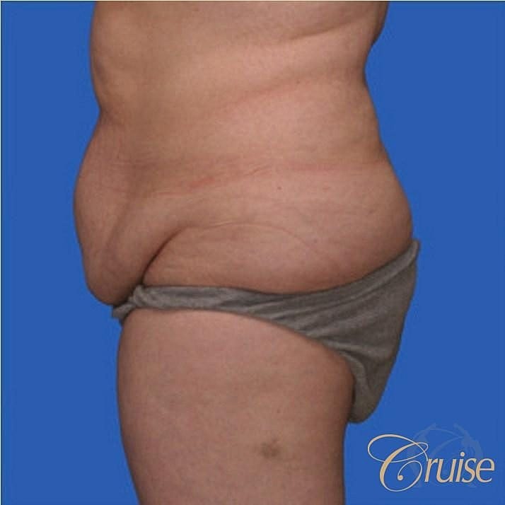 Tummy Tuck Before & After
