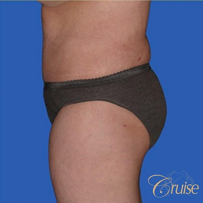 Tummy Tuck Before & After