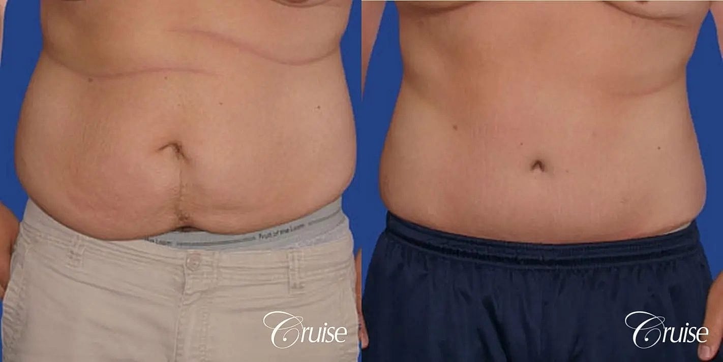 Tummy Tuck Before & After