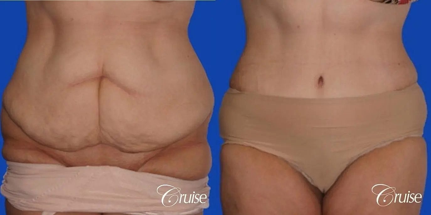 Tummy Tuck Before & After