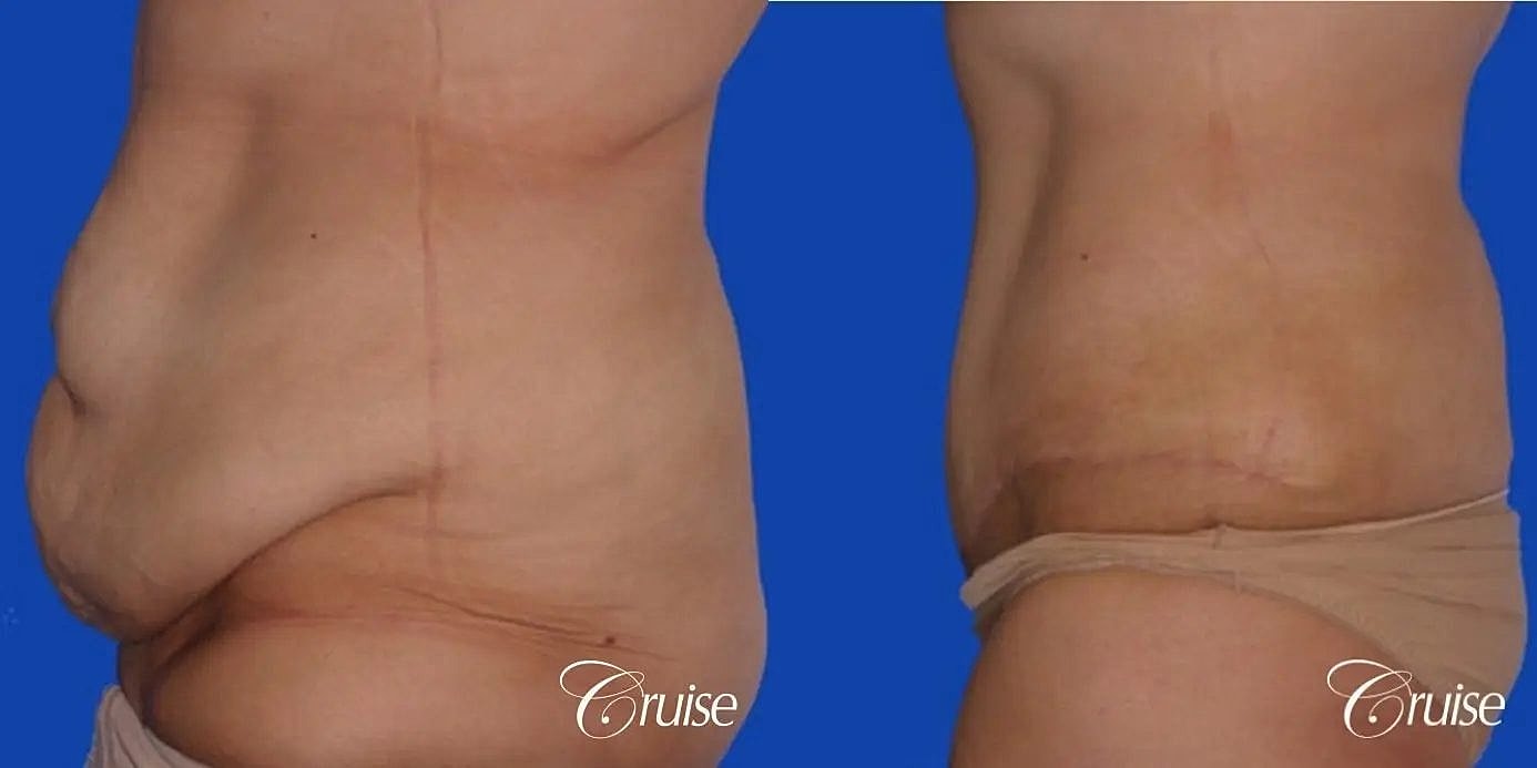 Tummy Tuck Before & After