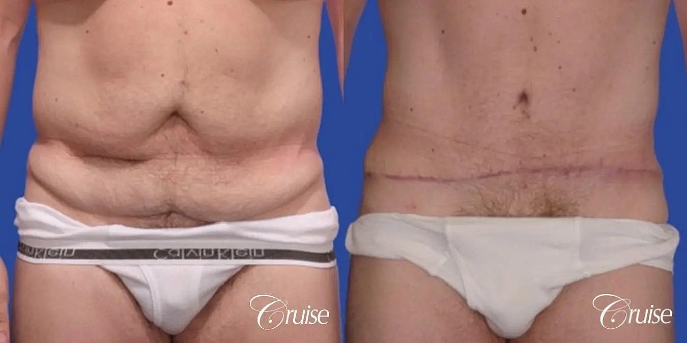 Tummy Tuck Before & After
