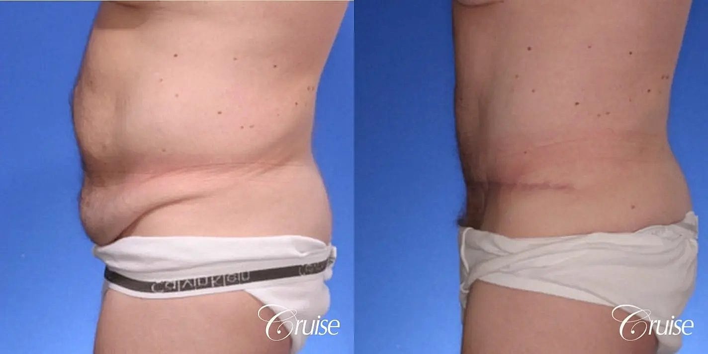 Tummy Tuck Before & After