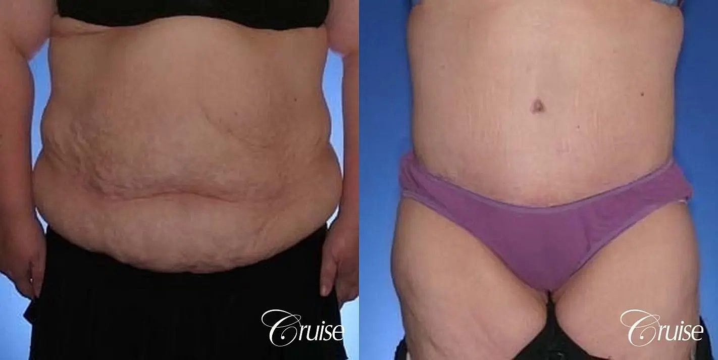 Tummy Tuck Before & After