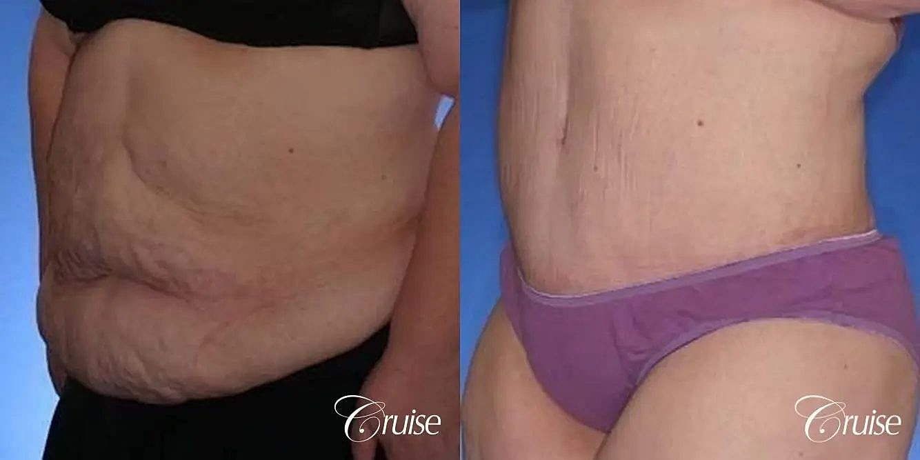 Tummy Tuck Before & After