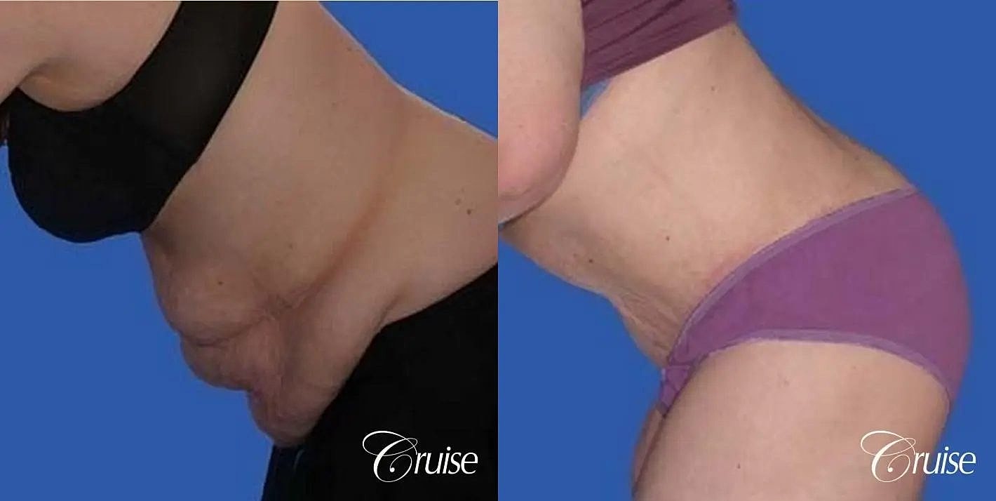 Tummy Tuck Before & After