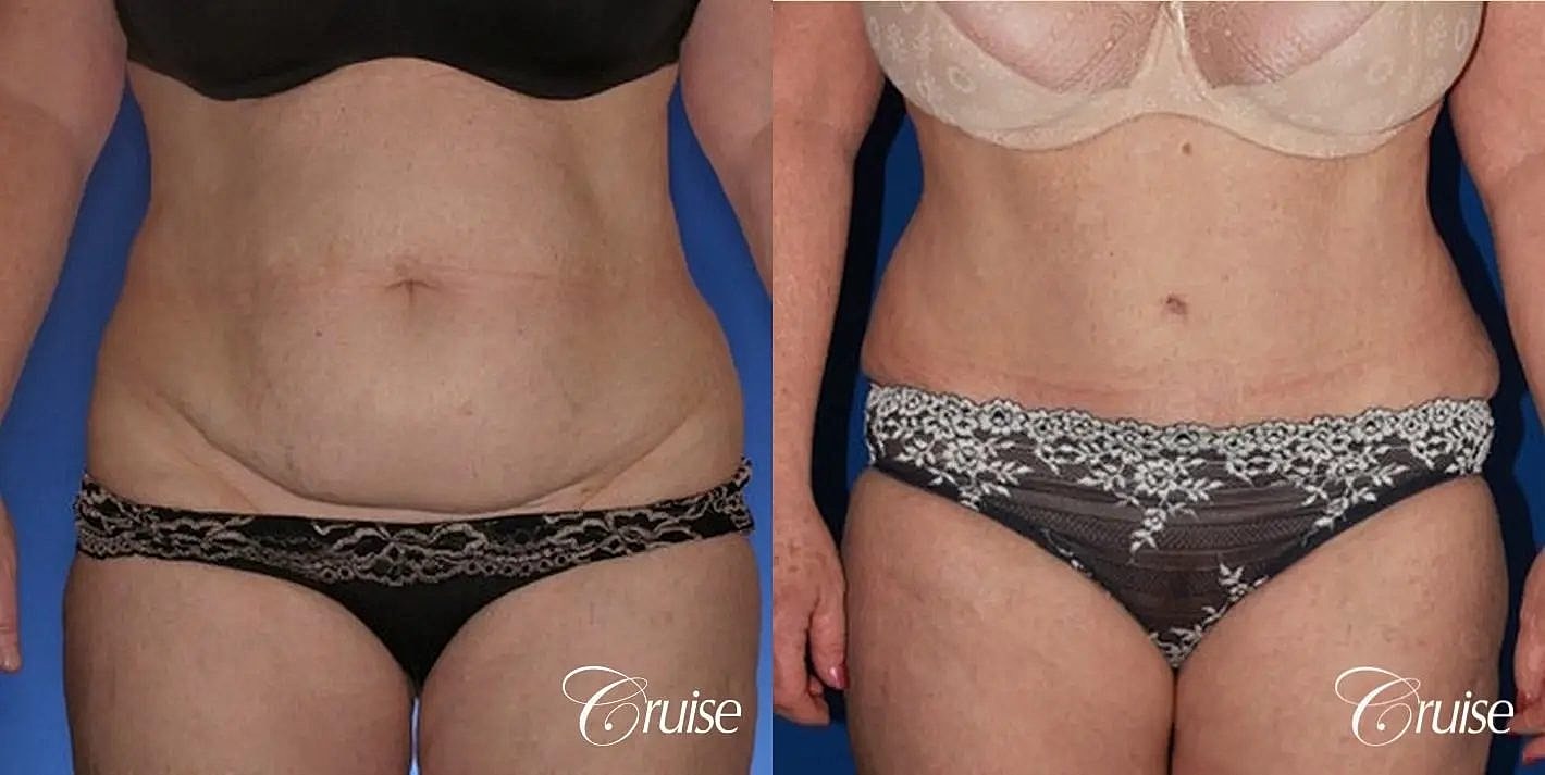 Tummy Tuck Before & After