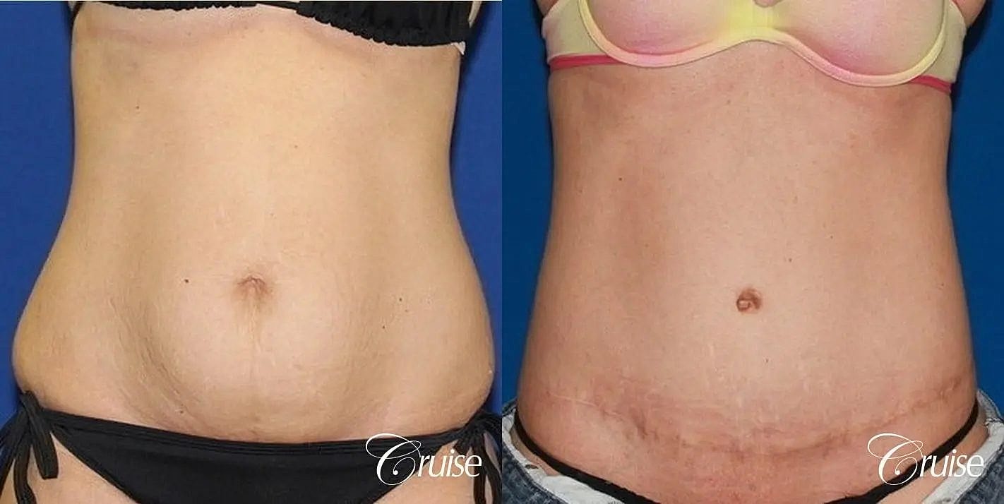 Tummy Tuck Before & After