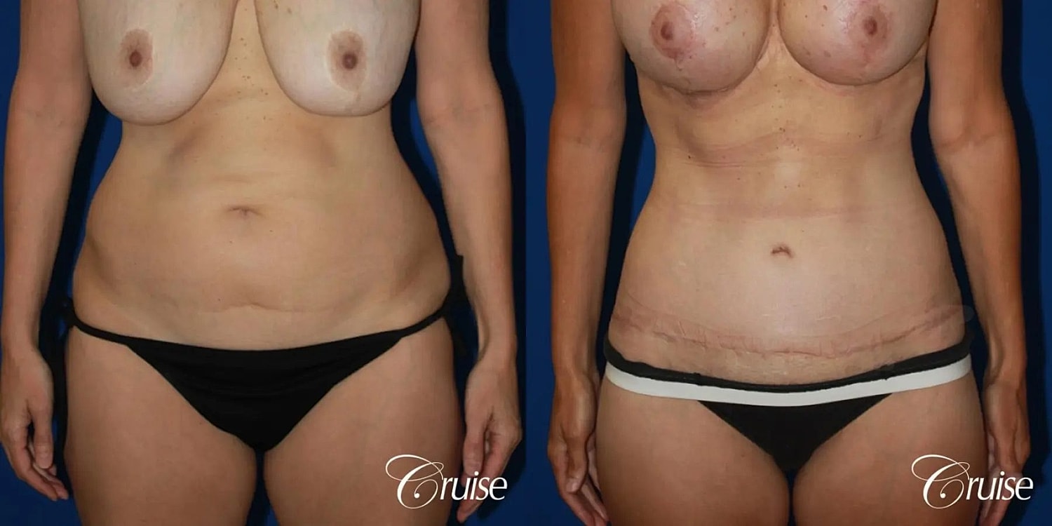 Tummy Tuck Before & After