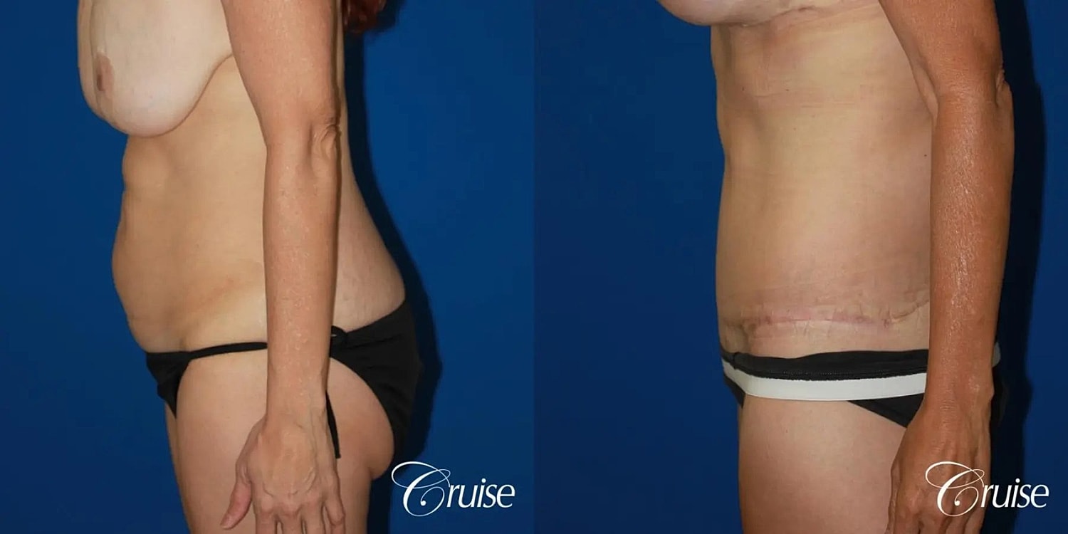 Tummy Tuck Before & After