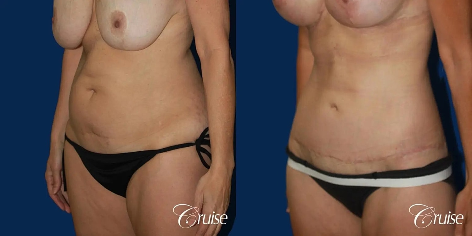 Tummy Tuck Before & After