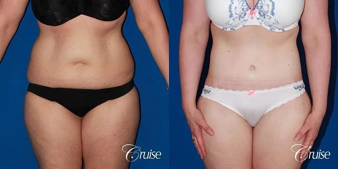 Tummy Tuck Before & After