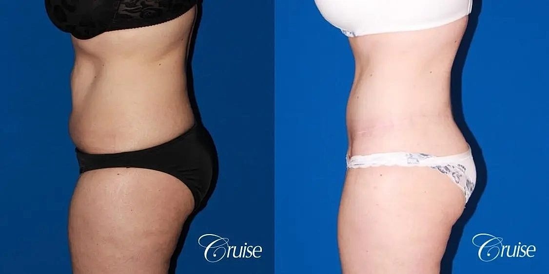 Tummy Tuck Before & After