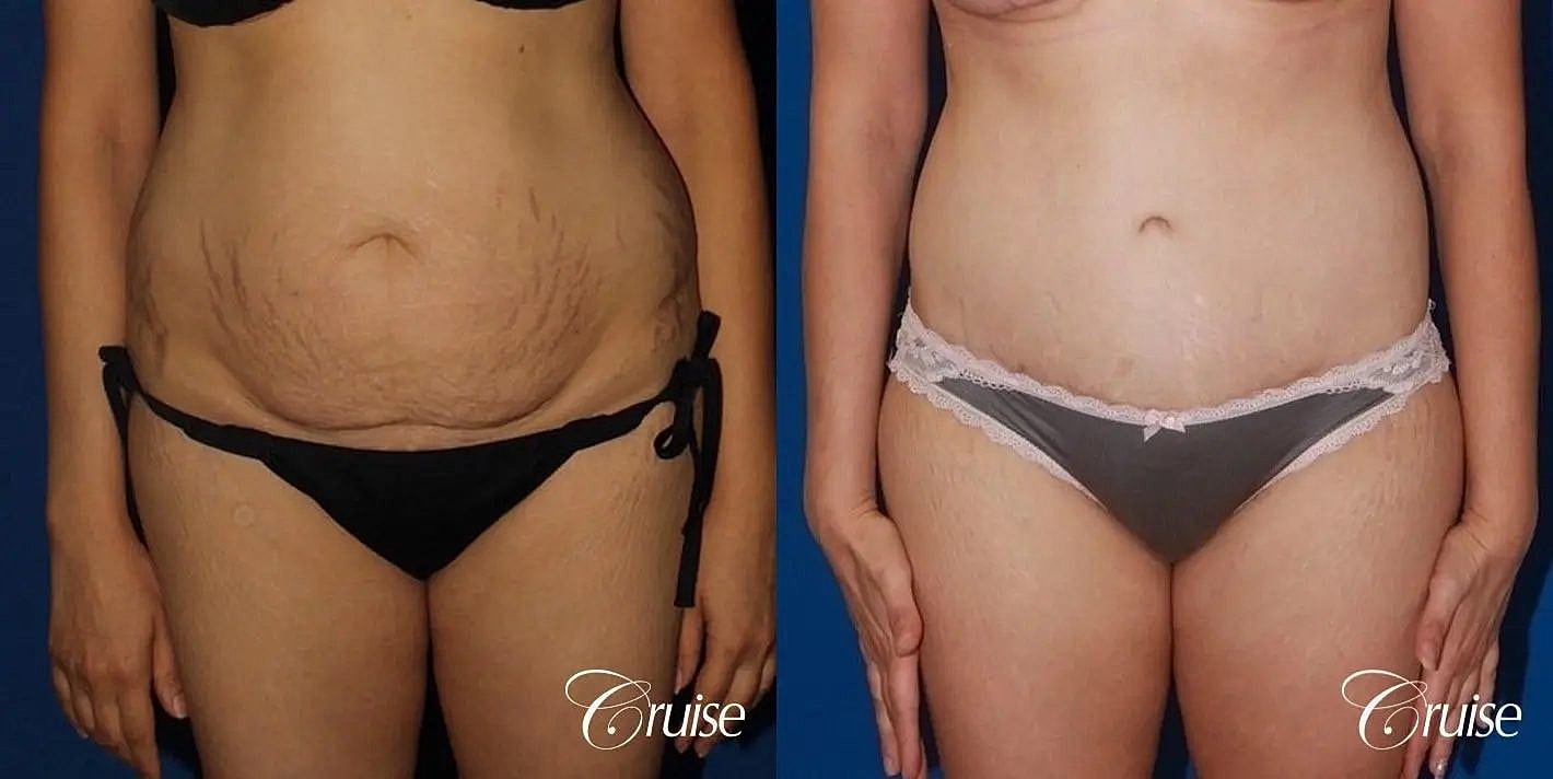 Tummy Tuck Before & After