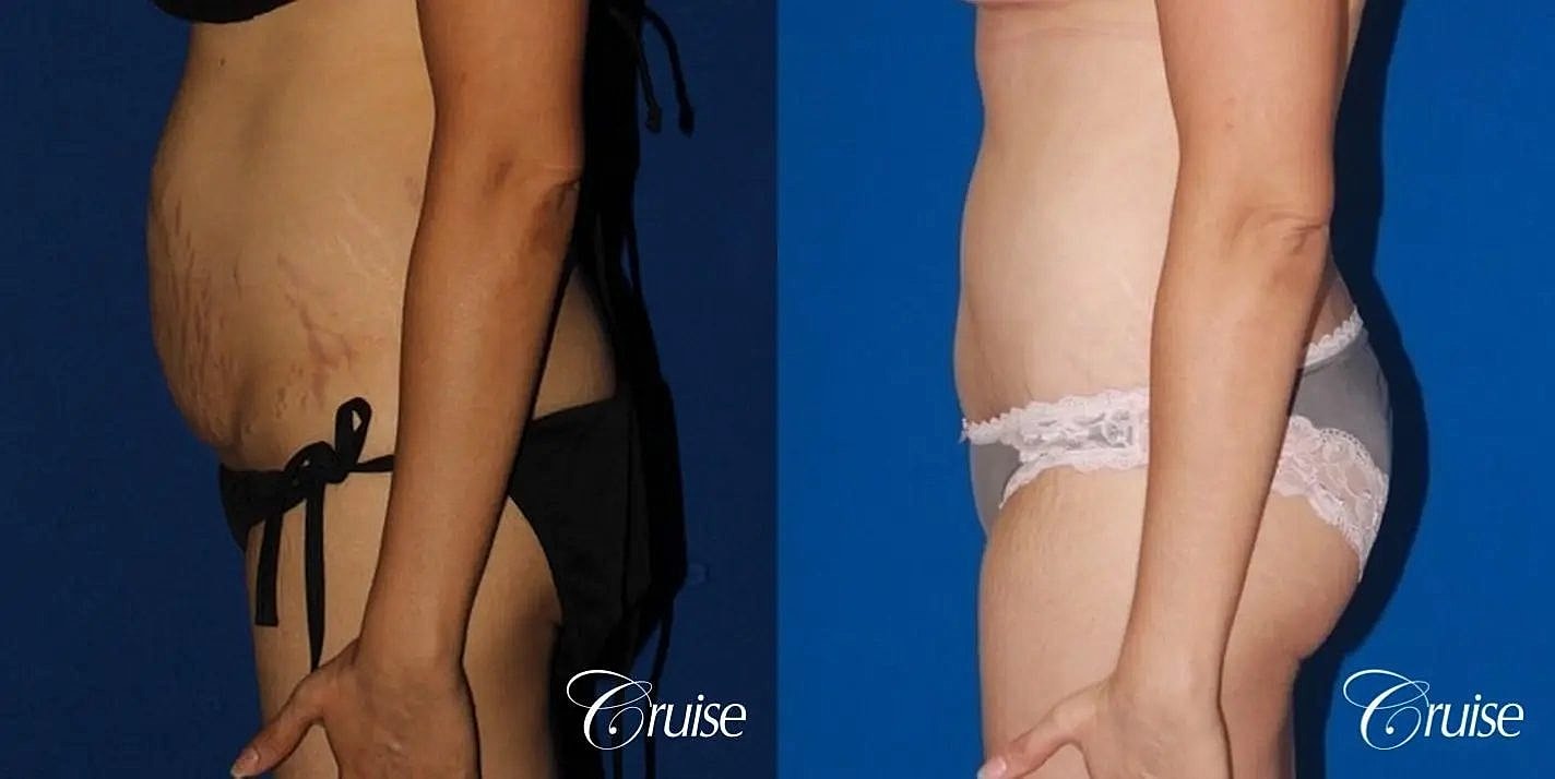 Tummy Tuck Before & After